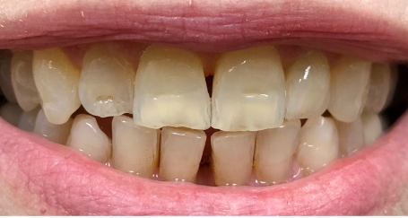 Discolored and damaged front top teeth